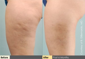 Cellulaze_BeforeAftersLineup_HR
