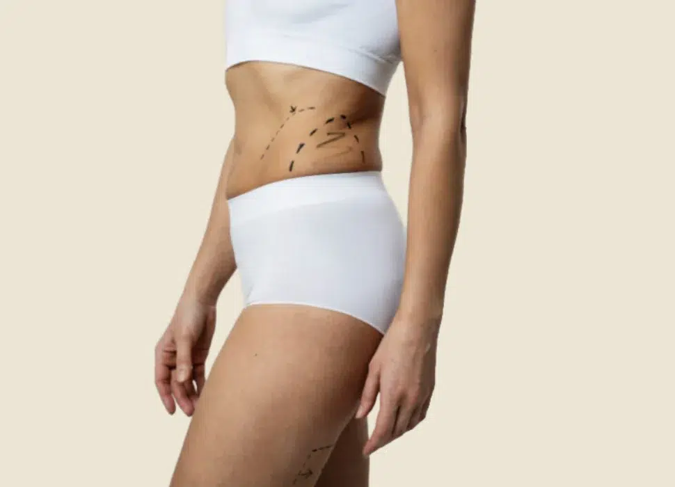 Consulta para liposucción en Sevilla