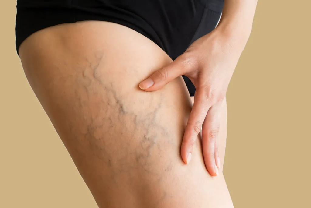 Tratamiento para varices en Sevilla