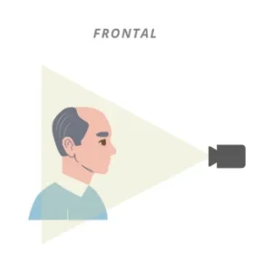 Tratamiento frontal capilar clínica Rocío Vázquez