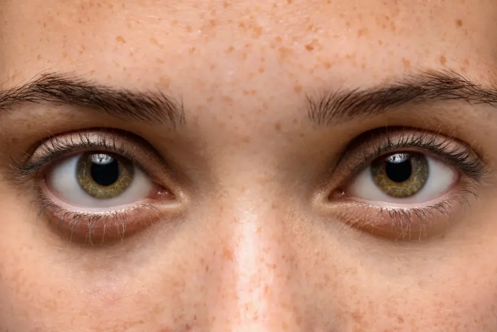 Tratamiento Thermage para los ojos en Sevilla