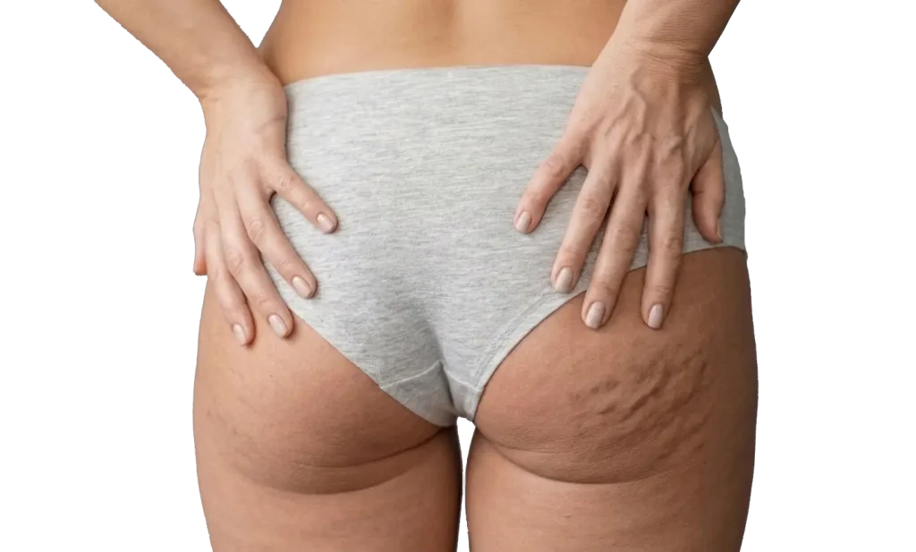Técnica de subcisión Diamond Incision liberando bandas fibrosas