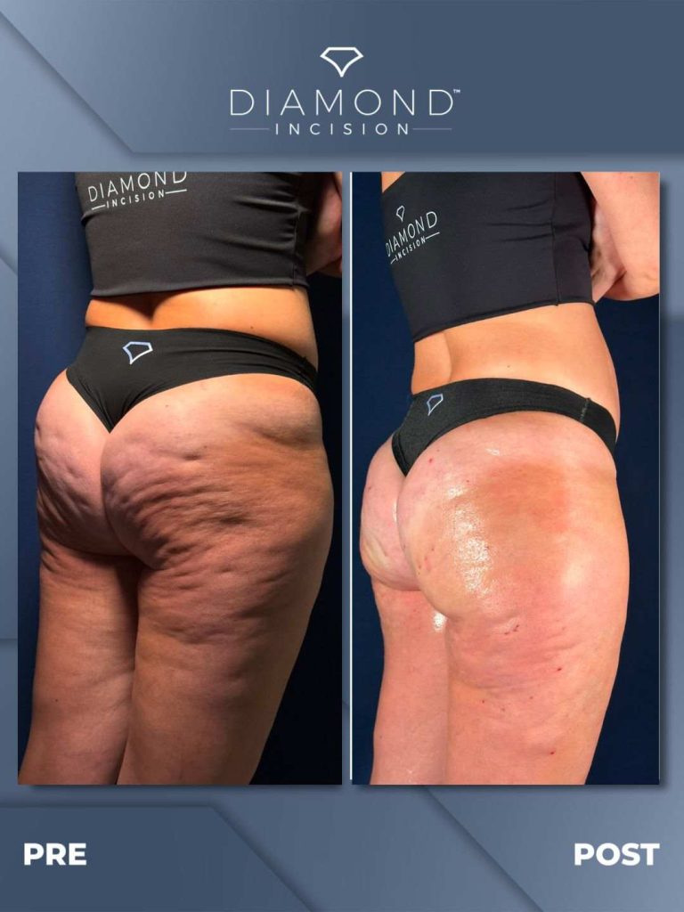 Tratamiento para la celulitis sin cirugía