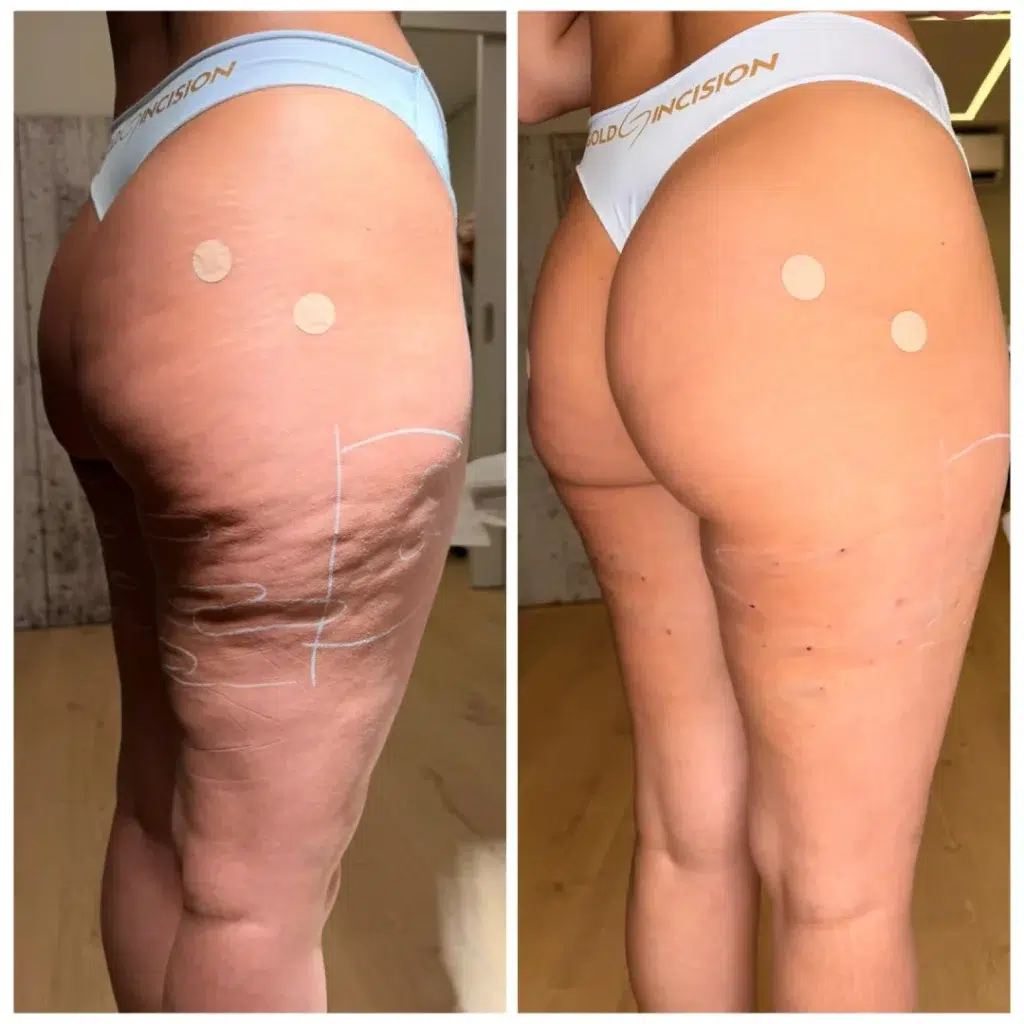 antes-despues-gold-incision
