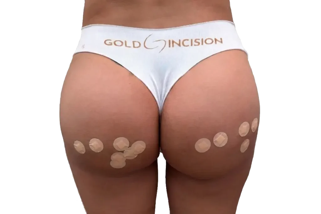 Técnica Gold Incision para liberar las bandas fibrosas de la celulitis