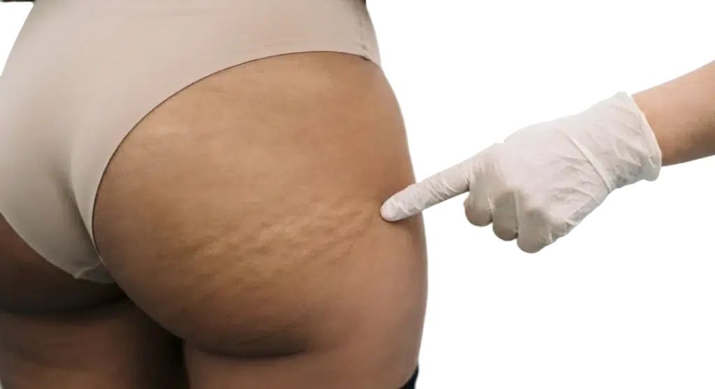 Tratamiento Gold Incision para mejorar la celulitis sin cirugía